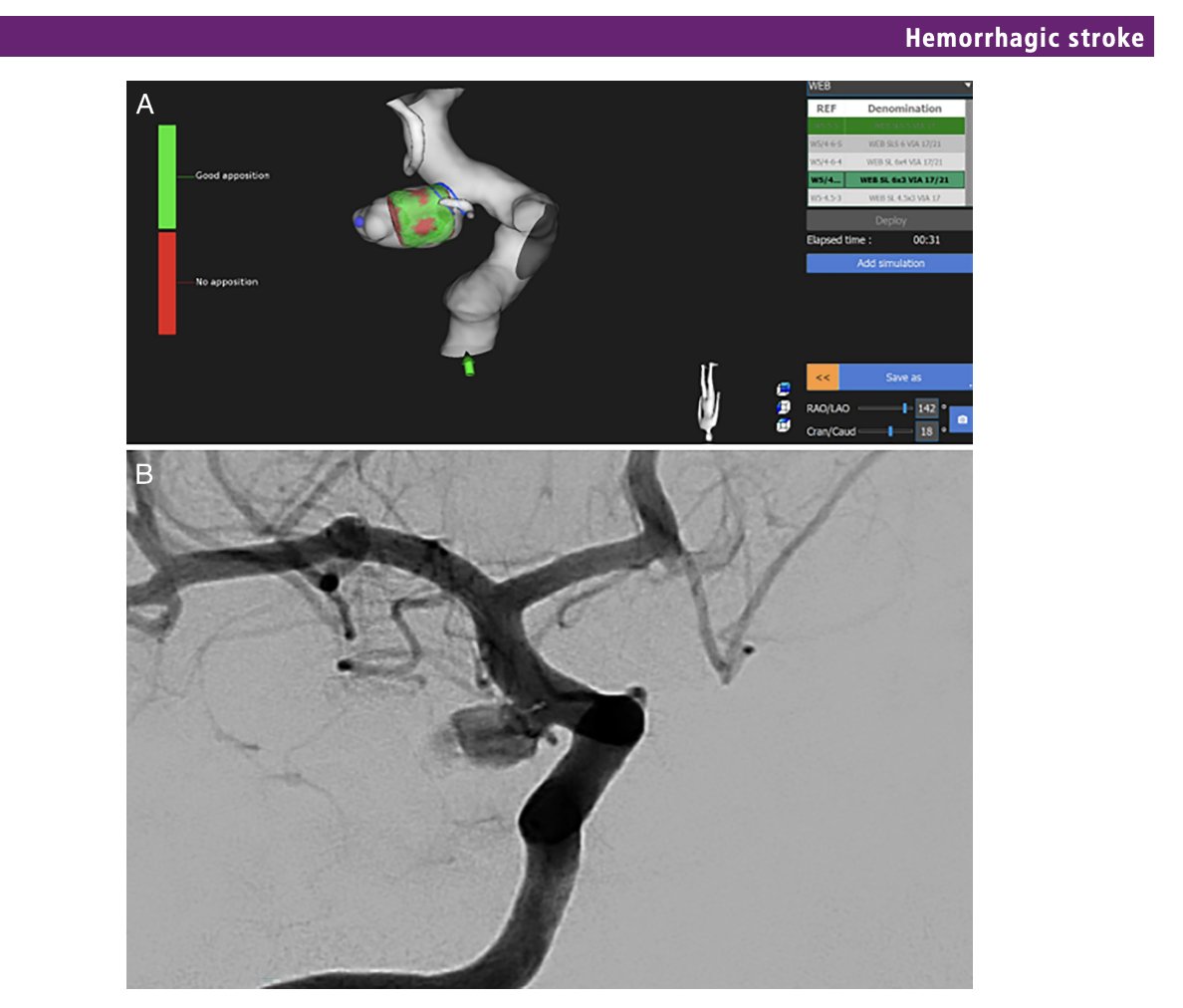 JNIS_BMJ's tweet photo. Does WEB sizing for aneurysms give you anxiety? 😵  This new paper shows that the use of Sim&amp;Size virtual simulation predicts aneurysm occlusion! https://t.co/RkQs7maADM https://t.co/vEqrb0rQ6f