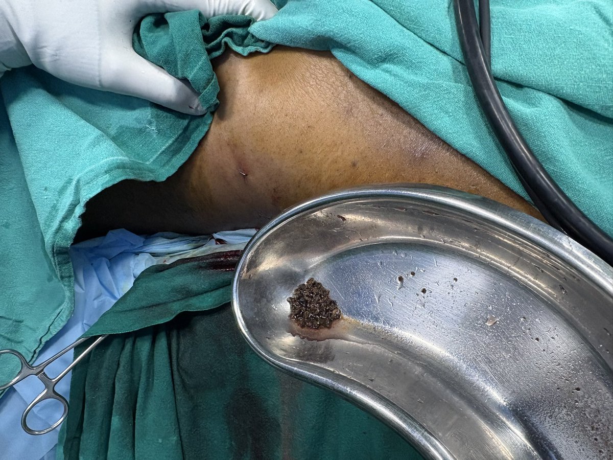 Nitesh Kumar (@niteshkuro) on Twitter photo Large 25*22 mm pelvic calculus.
HU 1500
Mini 16 F #supinepcnl
Lithotripsy time 40 mins (Holmium 2J 10 Hz Fragmentation mode).
When do you think it’s wiser to switch to larger tract or pneumatic energy.
<a href="/ValdiviaUria/">José Gabriel Valdivia Uría</a> <a href="/DrVCMohan/">Dr Vaddi Chandra Mohan</a> <a href="/ValdiviaUria/">José Gabriel Valdivia Uría</a> <a href="/StefaniaFerret/">Stefania Ferretti</a> <a href="/DrParimalGharia/">Dr Parimal Gharia</a> Large 25*22 mm pelvic calculus.
HU 1500
Mini 16 F #supinepcnl
Lithotripsy time 40 mins (Holmium 2J 10 Hz Fragmentation mode).
When do you think it’s wiser to switch to larger tract or pneumatic energy.
<a href="/ValdiviaUria/">José Gabriel Valdivia Uría</a> <a href="/DrVCMohan/">Dr Vaddi Chandra Mohan</a> <a href="/ValdiviaUria/">José Gabriel Valdivia Uría</a> <a href="/StefaniaFerret/">Stefania Ferretti</a> <a href="/DrParimalGharia/">Dr Parimal Gharia</a>