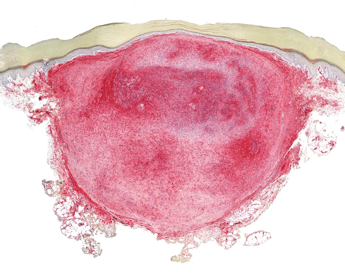 JMGardnerMD's tweet photo. Finger. Clinical dx: cyst. Stain: CD34. Your diagnosis? 
WSI digital slide 🔬 https://t.co/68kZ4m5XB9 
More stains: https://t.co/MZe1eBo0vc 
Answer ✅ https://t.co/9g4AqdZ2D6 
#pathology #pathologists #pathTwitter #dermpath #dermatology #dermtwitter #BSTpath https://t.co/8FqEUwT9LI