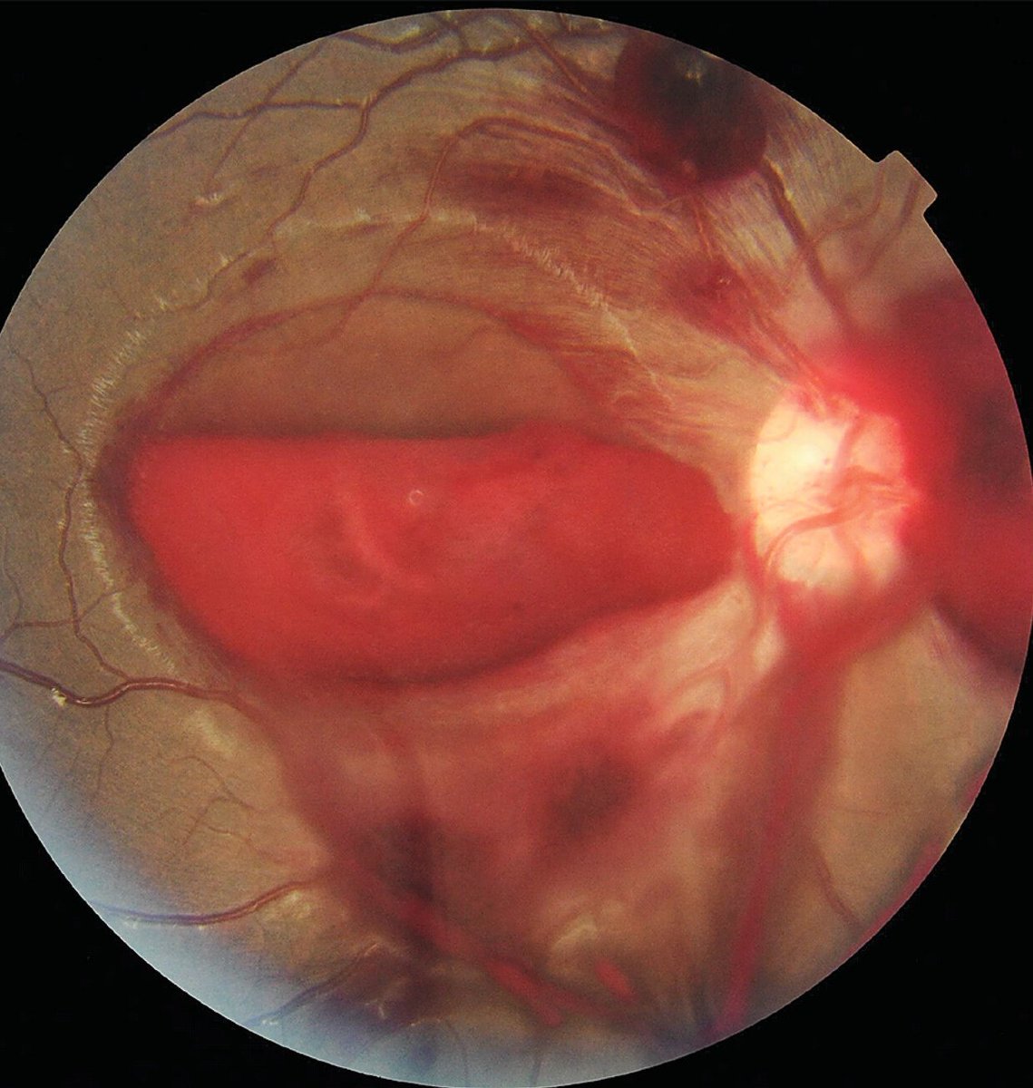 nihardesai7's tweet image. 30/โ๏ธ/ presents with epistaxis and blurry vision (R) eye ๐ญ
He is on warfarin for a mechanic mitral valve ๐ซ
Diagnosis?
Management?
#MedTwitter