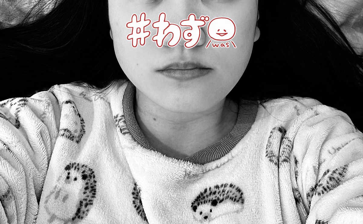 moni__Pi's tweet photo. 顎変（左右非対称+前突）両顎3日目
ドレーン抜去&amp;ゴム掛け1日目

・抜去痛かった方が特にお腫れ遊ばれている
・プレート&amp;ゴム掛け痛すぎ合ってます！？
・唇〜アゴの脱皮やばいけど唇だるだるにならんようにしてくれたらしい
・水の歯磨きで流血。ｱｶﾝ
・とにかく腫れ引かんと何とも言えん🥲 https://t.co/QcXOOp43KT