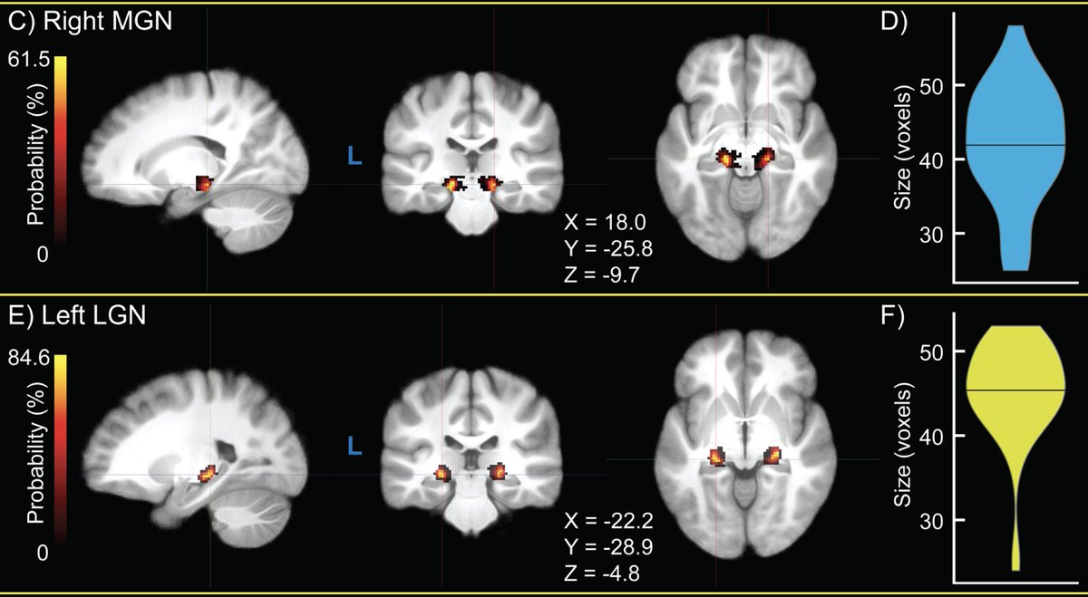 ImagingNeurosci's tweet photo. New paper in Imaging Neuroscience by John C. Williams, Jared X. Van Snellenberg, et al:

Functional localization of the human auditory and visual thalamus using a thalamic localizer functional magnetic resonance imaging task

https://t.co/QXMatopzkF https://t.co/QwTnP6kQj0
