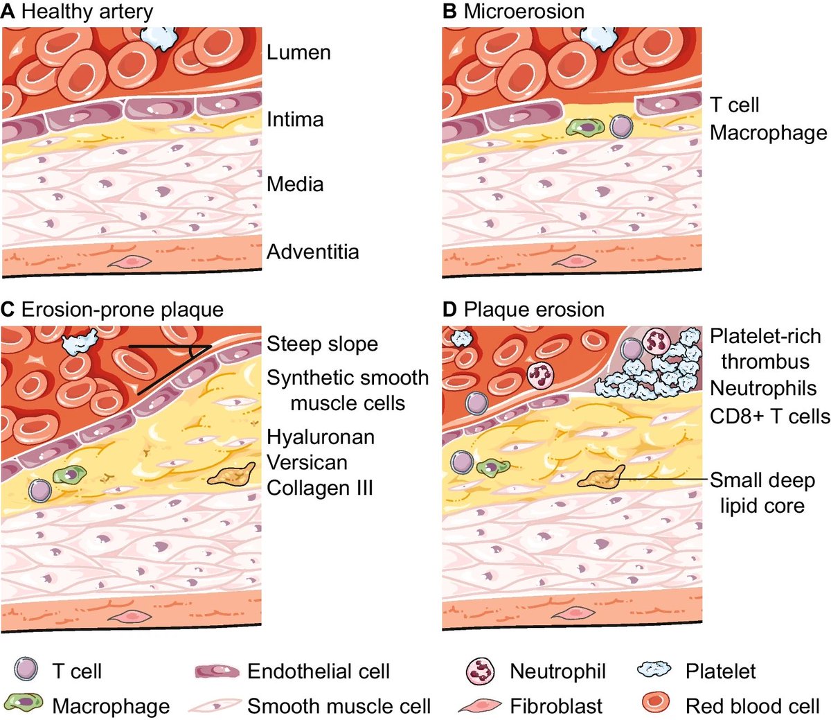 👸🏼 Wicked T cells at the Culprit Site 🧙🏾‍♀️
I’m excited to share our new review published in Current Atherosclerosis Reports focusing on plaque erosion.
Check out the paper using this link: link.springer.com/article/10.100…