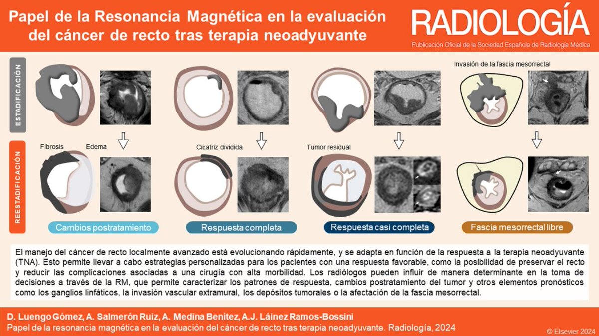 Esta revisión aborda los desafíos actuales que presenta la RM en la reestadificación del cáncer de recto tratado con TNA. ¡Ya en avance online! <a href="/sediabdomen/">SEDIA</a> 
elsevier.es/es-revista-rad…