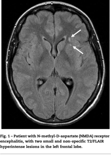 This review of the most common autoimmune encephalitis variants and associated MRI patterns highlights.
👌🧠

sciencedirect.com/science/articl…