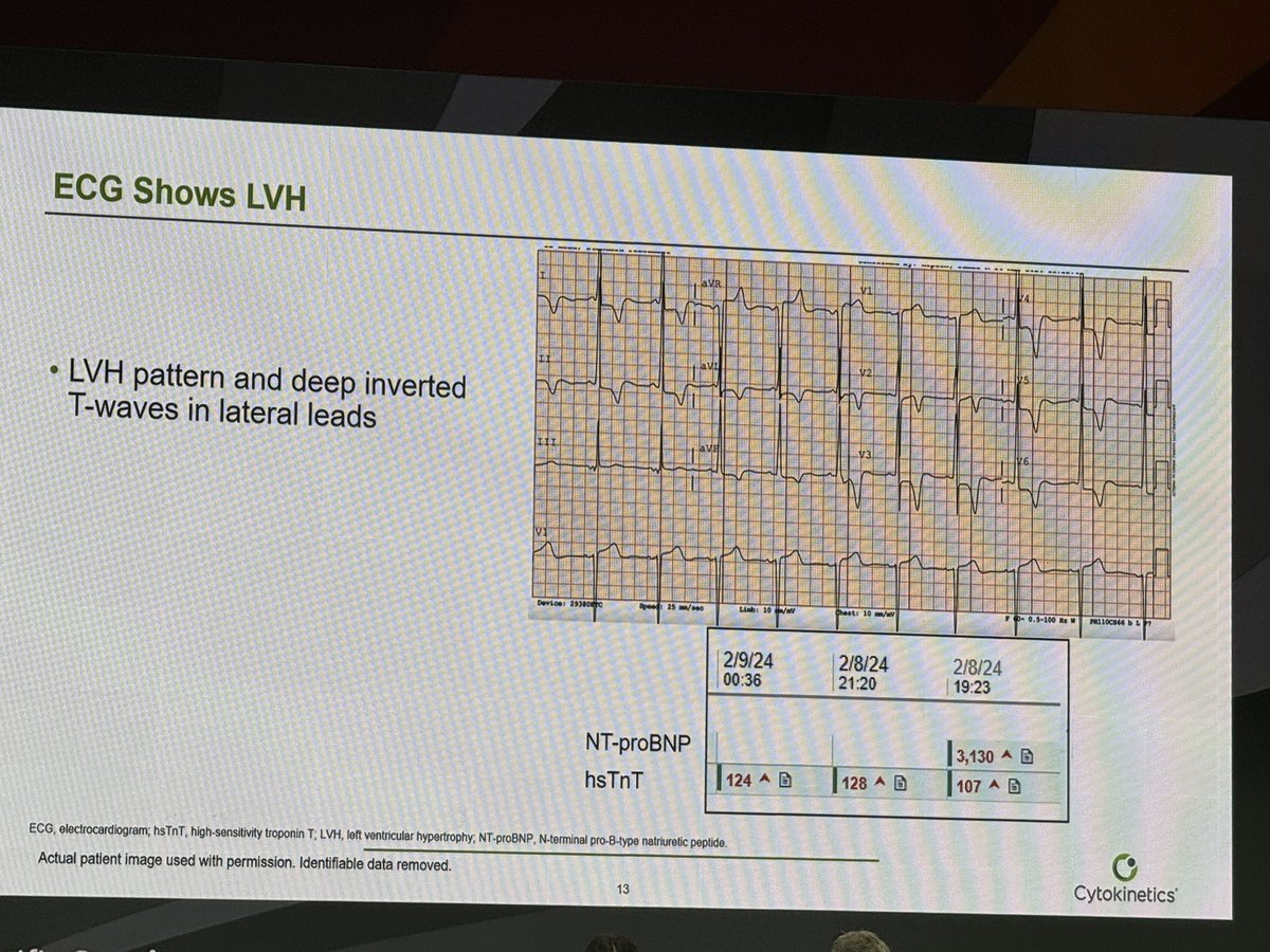 ZAALTai's tweet image. Great case presentation on missed HCM Dx: 56F with no PMHx, diagnosed with anxiety for intermittent SOB. 3 years later, ER visit for SOB led to EKG & Echo revealing HCM Dx. ~55% of HCM cases go undiagnosed. When something feels wrong, dig deeper—patients count on us.