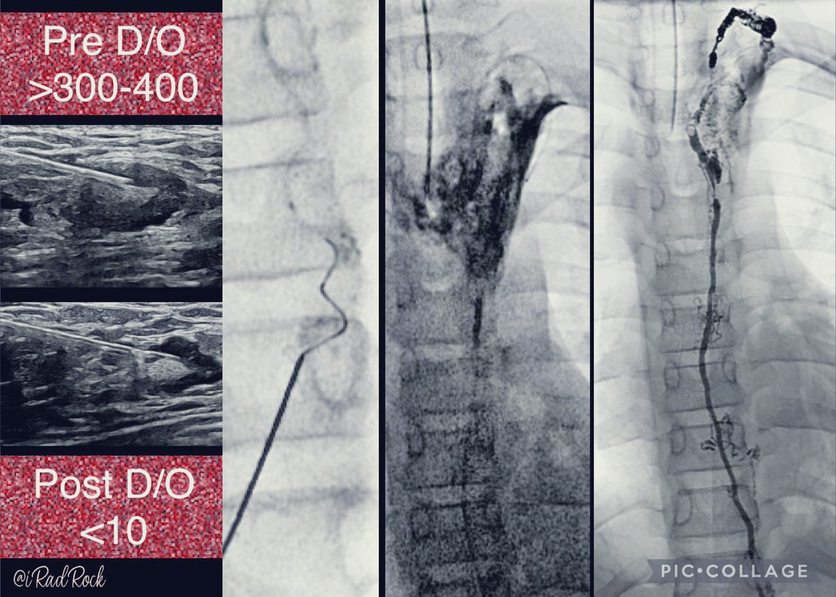 πππ ππ¨π π. πΌππͺππ, ππΏ (@iradrock) on Twitter photo Thoracic duct embo can be a life altering procedure even in small children. 7yo with post operative chylous effusion due to thoracic duct transection. TD emboβ‘οΈComplete resolution of chylous effusionβ‘οΈchest tube outβ‘οΈpatient with complete recovery. #VIRad <a href="/SIR_ECS/">SIR ECS</a> <a href="/SIRspecialists/">Society of Interventional Radiology</a> Thoracic duct embo can be a life altering procedure even in small children. 7yo with post operative chylous effusion due to thoracic duct transection. TD emboβ‘οΈComplete resolution of chylous effusionβ‘οΈchest tube outβ‘οΈpatient with complete recovery. #VIRad <a href="/SIR_ECS/">SIR ECS</a> <a href="/SIRspecialists/">Society of Interventional Radiology</a>