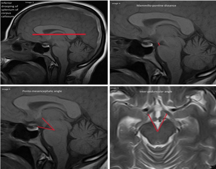 DocNavarrow's tweet photo. 💡Brain sagging signs like reduced mamillo-pontine distance, ponto-mesencephalic and interpeduncular angles, and splenium drooping are key MRI findings in primary intracranial hypotension🗝️🔐
https://t.co/BFk3jVFCTx https://t.co/giKy6xQQ72