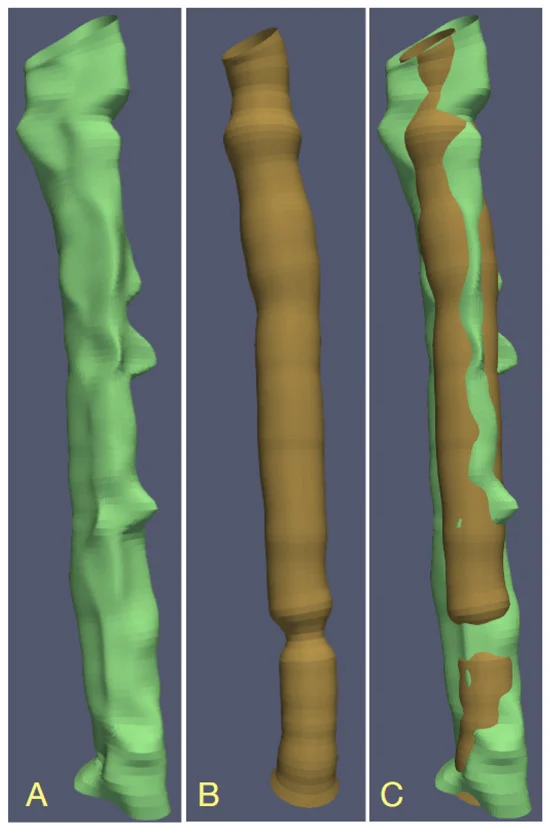 Sensors_MDPI's tweet image. Using Deep Learning and B-Splines to Model Blood Vessel Lumen from 3D Images
mdpi.com/1424-8220/24/3…
#bloodvessels #deeplearning #3Dimages