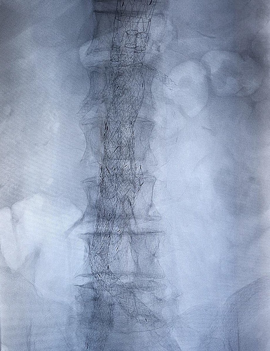 UCIrvine Vascular Surgery (@ucivascularsurg) on Twitter photo Our UCI/VA teams performed their first two TAMBE stent grafts. 👏🏻Both done for late failures of EVAR years ago. <a href="/RMFujitaniMD/">Roy M Fujitani</a> <a href="/chauvascular/">Anthony H. Chau</a> <a href="/Kabutey_MD/">Nii-Kabu Kabutey</a> <a href="/SamuelChenMD/">Samuel Chen</a> <a href="/IsabellaKuoMD/">Isabella Kuo</a> _ Steven Kubaska _Sheela Patel _ Sylvia Dong <a href="/Delgadillo3D/">Daniel Delgadillo, MD</a> _ Taylor Orton <a href="/WLGore/">Gore</a> Our UCI/VA teams performed their first two TAMBE stent grafts. 👏🏻Both done for late failures of EVAR years ago. <a href="/RMFujitaniMD/">Roy M Fujitani</a> <a href="/chauvascular/">Anthony H. Chau</a> <a href="/Kabutey_MD/">Nii-Kabu Kabutey</a> <a href="/SamuelChenMD/">Samuel Chen</a> <a href="/IsabellaKuoMD/">Isabella Kuo</a> _ Steven Kubaska _Sheela Patel _ Sylvia Dong <a href="/Delgadillo3D/">Daniel Delgadillo, MD</a> _ Taylor Orton <a href="/WLGore/">Gore</a>
