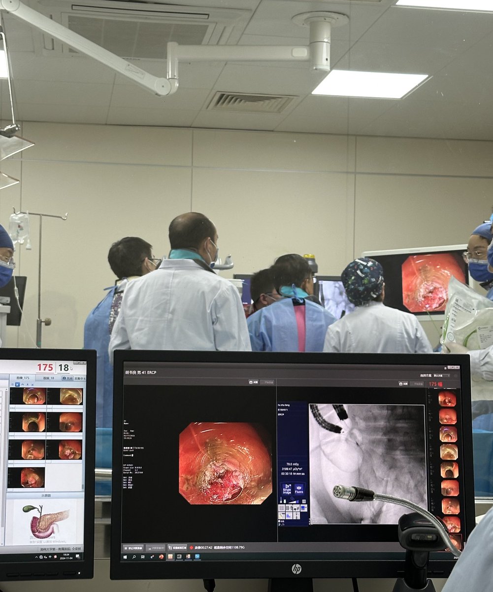 Endoscopic retrograde appendicitis treatment (ERAT) performed by Dr. Bingrong Liu and his team at The First Affiliated Hospital of Zhengzhou University. Innovative procedure developed by this endoscopy team to treat uncomplicated appendicitis #endoscopy #appendicitis