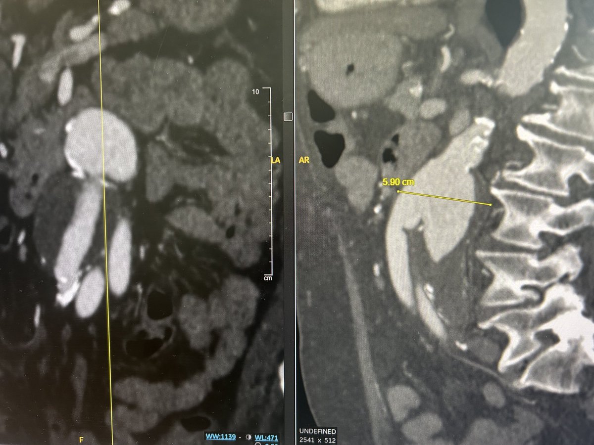 cfbechara (@cfbechara) on Twitter photo End-side ABF, with degenerated ~6cm proximal anastomosis, occluded bil EIA, patent right IIA. High risk for open repair, vague abd pain. We did evar, renal laser fen, and outer branch for the right IIA preserving pelvic flow <a href="/RDebbieLi/">R. Debbie Li</a> showing off her skills! #aortaed End-side ABF, with degenerated ~6cm proximal anastomosis, occluded bil EIA, patent right IIA. High risk for open repair, vague abd pain. We did evar, renal laser fen, and outer branch for the right IIA preserving pelvic flow <a href="/RDebbieLi/">R. Debbie Li</a> showing off her skills! #aortaed