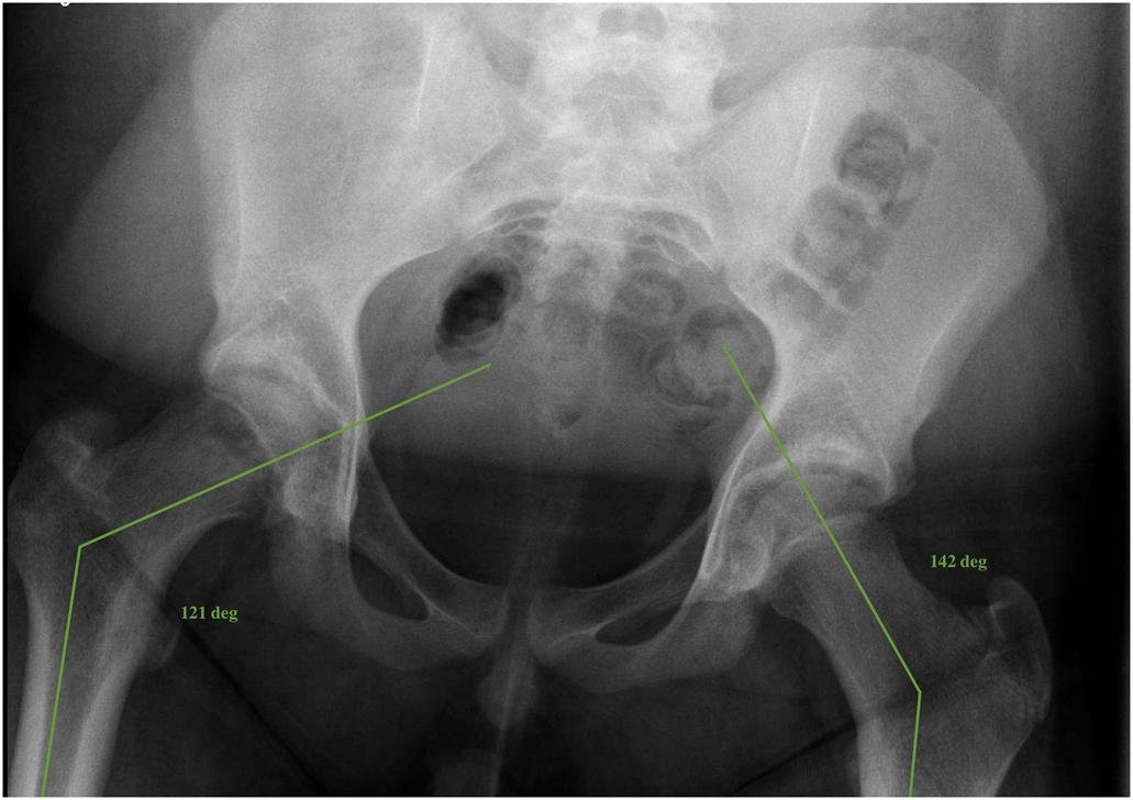 Slipped Capital Femoral Epiphysis in an Adolescent Undergoing Gender-Affirming Therapy with a Gonadal-Releasing Hormone Analog

bit.ly/40OKwor