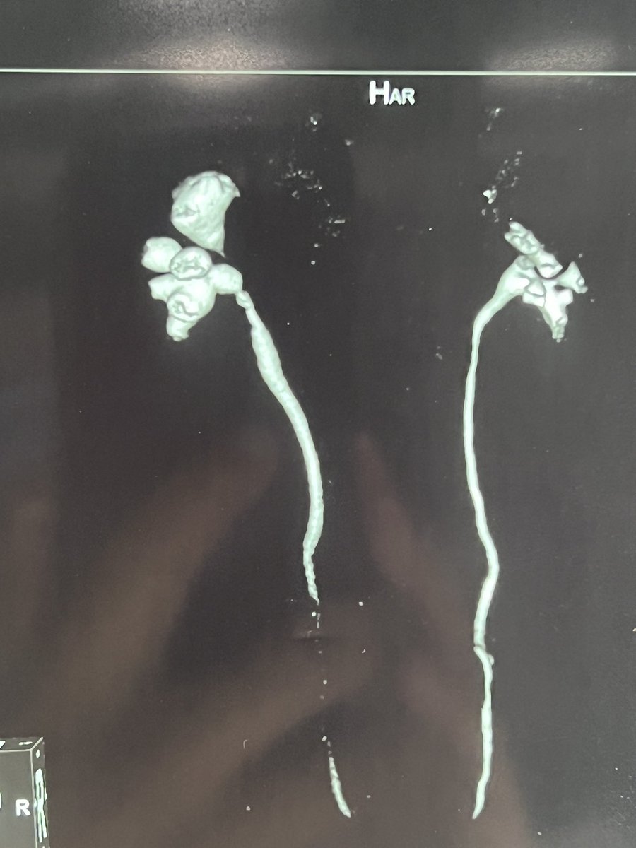 Recons can provide beautiful calyceal anatomy! <a href="/endouroacademy/">Endourology Academy</a> <a href="/PETRAurogroup/">PETRA</a> <a href="/Endo_Society/">Endourological Society</a> <a href="/EndourologyT/">T&T Endourology</a> <a href="/GuidoGiusti/">Guido Giusti</a> <a href="/SKPal04031957/">S K Pal</a> #PERC
NCCT v CECT for PERC your view!