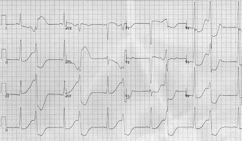 Curveball Case 003: Post-op cardiac arrest, VF, and a puzzling ECG. How do you manage this 57-year-old's complex arrhythmias? #FOAMed #MedTwitter #MedEd litfl.com/cardiac-megaco…