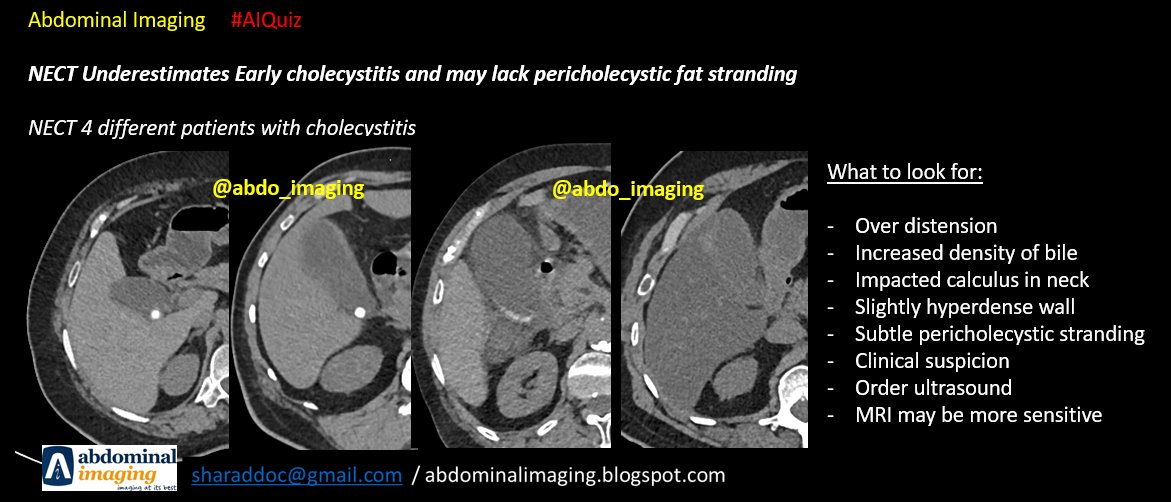 abdo_imaging's tweet image. Abdominal Imaging #AIQuiz

Early cholecystitis can be missed on NECT. Clinically they may not present with full signs, especially if diabetic and elderly.

Clinical suspicion, LFT and further imaging  like ultrasound or MRI may help.

#FOAMrad #FOAMed #radtwitter @AJR_Radiology