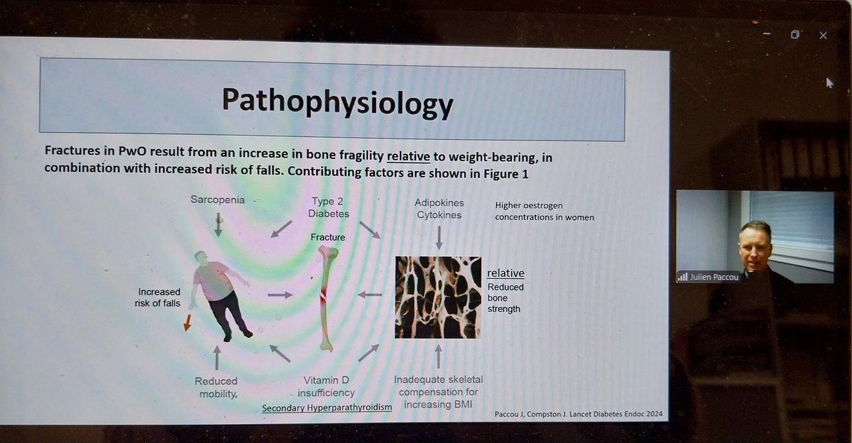 Elena Tsourdi (@elena_tsourdi) on Twitter photo The pathophysiology of bone fragility in people living with obesity is multifaceted and fractures can occur despited preserved BMD as explained by <a href="/Julienpaccoujp7/">Julienpaccou@yahoo.fr</a> #ECTSClinicalTrainingCourse <a href="/ECTS_science/">ECTS_Science</a> <a href="/ECTS_soc/">ECTS</a> <a href="/AcademyEcts/">ECTS Academy</a> The pathophysiology of bone fragility in people living with obesity is multifaceted and fractures can occur despited preserved BMD as explained by <a href="/Julienpaccoujp7/">Julienpaccou@yahoo.fr</a> #ECTSClinicalTrainingCourse <a href="/ECTS_science/">ECTS_Science</a> <a href="/ECTS_soc/">ECTS</a> <a href="/AcademyEcts/">ECTS Academy</a>