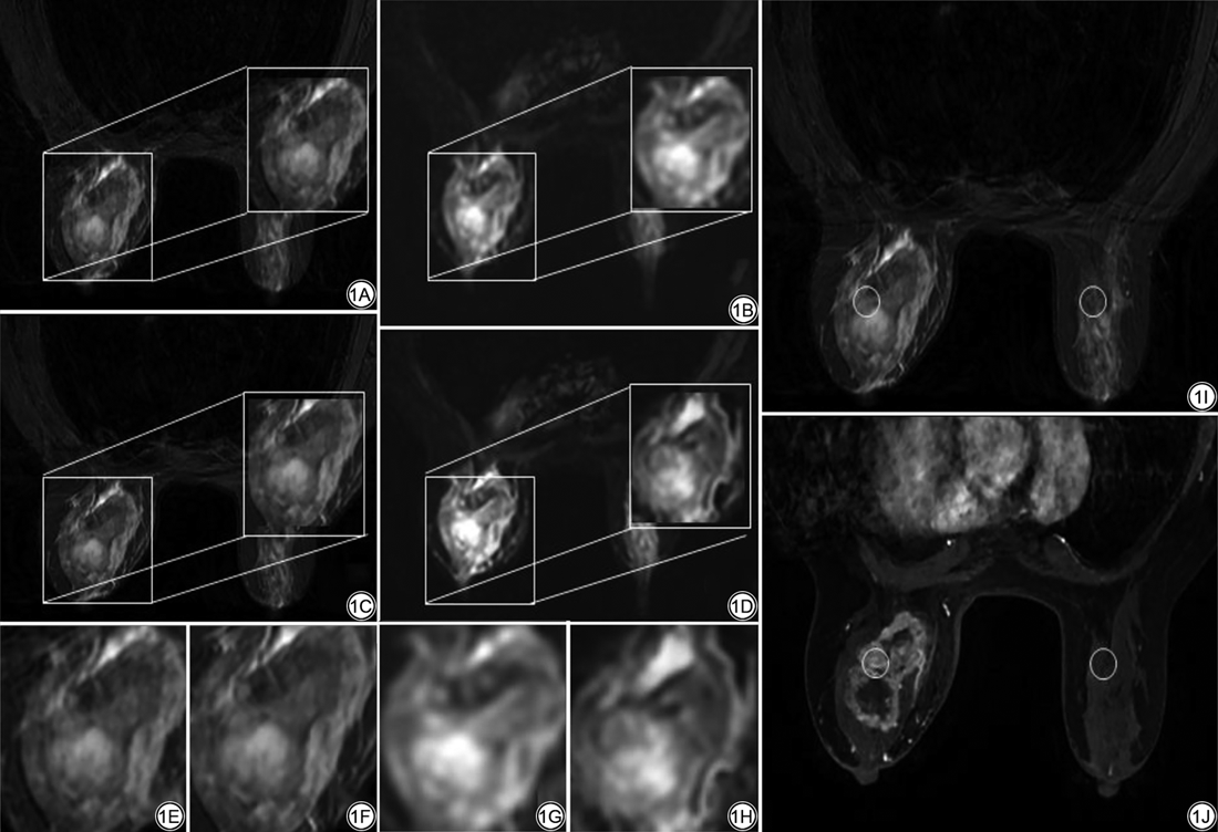 CJMRI_2010's tweet photo. #DL Recon can significantly improve the image quality of rapidly acquired breast MRI sequences while shortening scan time across different modalities. This advancement is beneficial for promoting the clinical application of fast breast #MRI sequences.
https://t.co/j4ryj3QDHb https://t.co/umgCUmpZZd