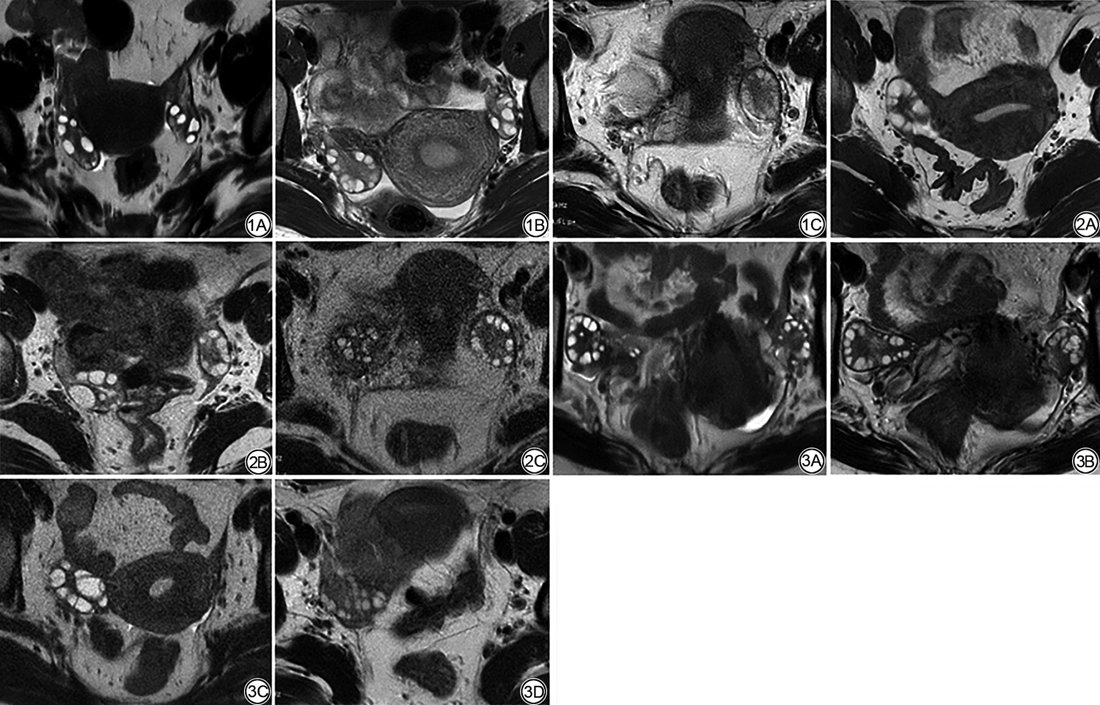 CJMRI_2010's tweet photo. #SSFSE-DLR images significantly improved the display of ovarian morphology and the repeatability of follicle counting, thereby fortifying the reliability of future polycystic ovary morphology determinations.
https://t.co/dimwQPKnn0 https://t.co/TBlFDSsaCc