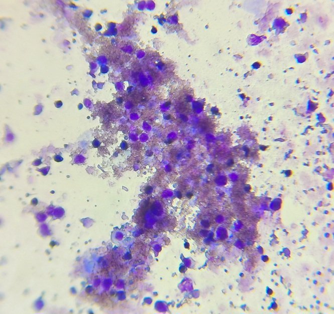 Lisa Andrology Lab Petr贸polis, RJ, Brazil馃嚙馃嚪 (@lisaandrollab) on Twitter photo <a href="/Lisaandrollab/">Lisa Andrology Lab Petr贸polis, RJ, Brazil馃嚙馃嚪</a> Images from Advanced Semen Analysis. Mucin gel from the prostate with significant sperm aggregation. <a href="/Lisaandrollab/">Lisa Andrology Lab Petr贸polis, RJ, Brazil馃嚙馃嚪</a> Images from Advanced Semen Analysis. Mucin gel from the prostate with significant sperm aggregation.
