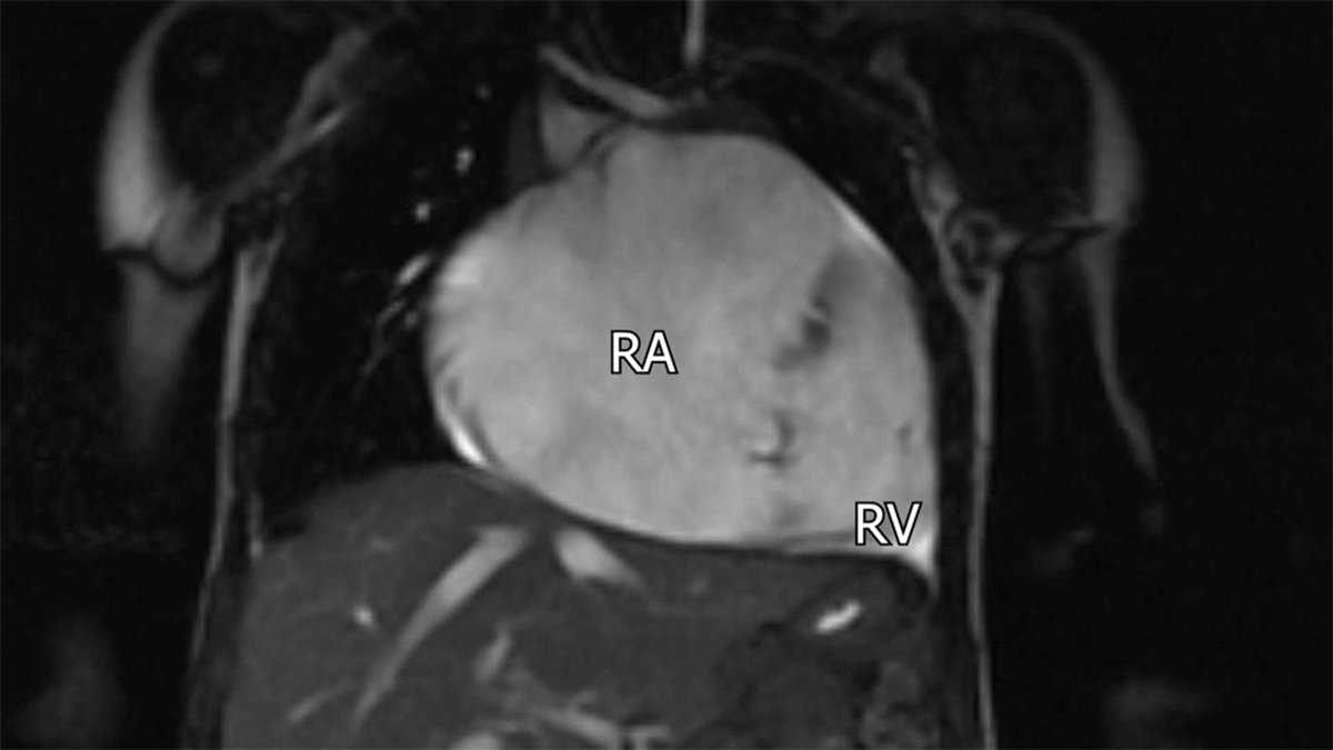 AATS (@aatshq) on Twitter photo #TechniquesTuesday: Surgeons at <a href="/ChildrensPgh/">UPMC Children's Hospital of Pittsburgh</a> published a case report on a 17-month-old female with Ebstein anomaly variant with anterior leaflet displacement. Read more in #JTCVS Techniques: doi.org/10.1016/j.xjtcā¦
<a href="/LFonsecaDaSilva/">Luciana Fonseca da Silva</a> <a href="/Irsa_Hasan/">Irsa Hasan</a> <a href="/UPMC_CTSurgery/">Pitt Cardiothoracic Surgery Department</a> #TechniquesTuesday: Surgeons at <a href="/ChildrensPgh/">UPMC Children's Hospital of Pittsburgh</a> published a case report on a 17-month-old female with Ebstein anomaly variant with anterior leaflet displacement. Read more in #JTCVS Techniques: doi.org/10.1016/j.xjtcā¦
<a href="/LFonsecaDaSilva/">Luciana Fonseca da Silva</a> <a href="/Irsa_Hasan/">Irsa Hasan</a> <a href="/UPMC_CTSurgery/">Pitt Cardiothoracic Surgery Department</a>