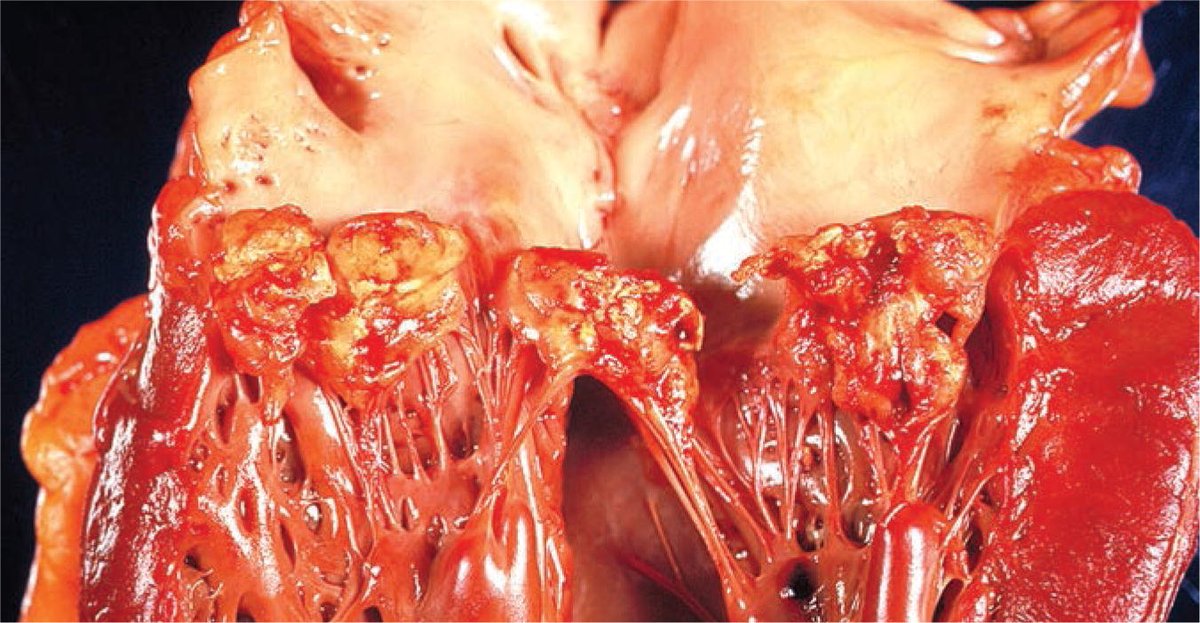 ARP_Press's tweet image. More #IDpath (arppress.org/books/book/65):
S. aureus is the most frequent cause of infective endocarditis and the left side (esp. mitral valve) is most frequently affected; vegetations can be seen (image). Possible complications: valve leaflet perforation, chordae tendineae rupture.