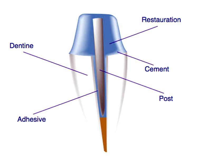 OviDentalGo's tweet image. LINK odontologiavirtual.com/2014/05/intra-…

The aim of this study was to evaluate the effect of treating intraradicular dentin with irrigating solutions on the retention of glass-fiber posts luted with self-adhesive resin cement.

#FiberPosts #Endodontics #Prosthodontics #Ovidental