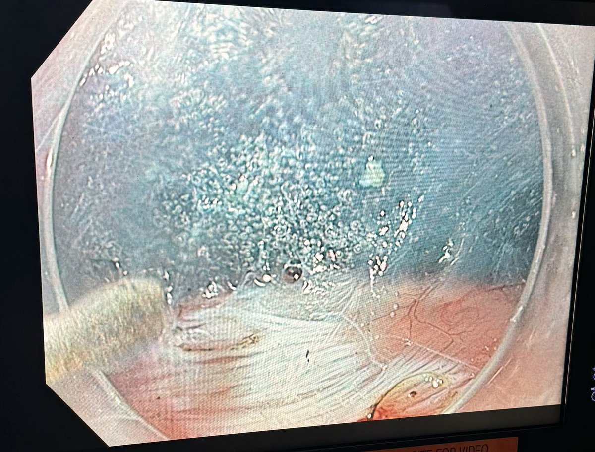 ElliotServaisMD's tweet image. Patient unable to swallow

What’s happening in this image?
Procedure?
Anatomy?

#MedTwitter #GITwitter #thoracic #endoscopy