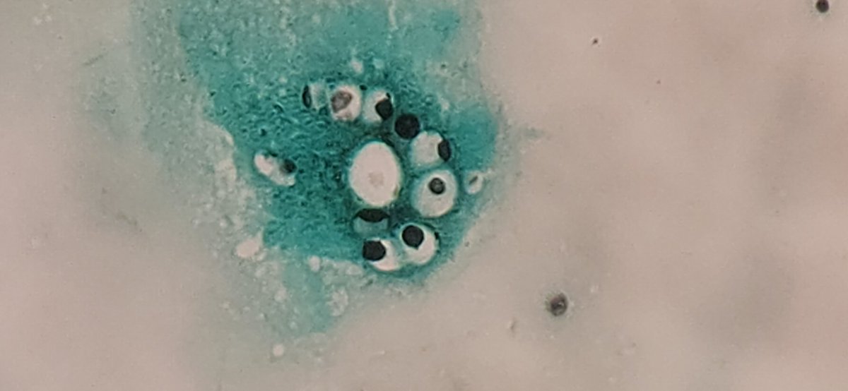 FlorentMorio's tweet image. 🔬Live from the clinical lab: direct examination after grocott methenamine silver staining of a skin biopsy in a patient with disseminated cryptococcosis. Cryptococcus neoformans yeast cells surrounded by a large capsule. 👀
#cryptococcus 
#thinkfungus