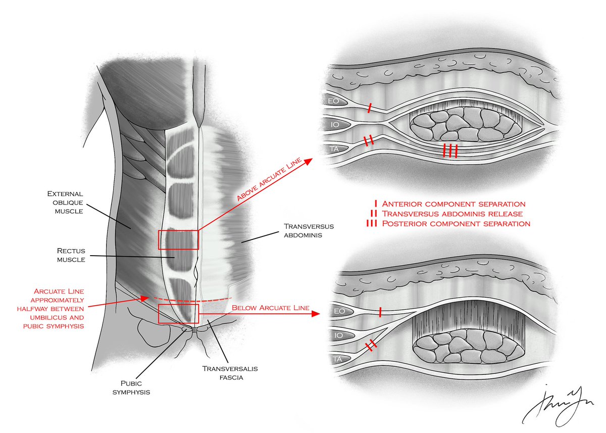 BehindTheKnife (@behindtheknife) on Twitter photo As the field of hernia surgery has matured, so have training paradigms. What are the latest requirements and trends 📈 ?
Join <a href="/AtriumHealth/">Atrium Health</a> <a href="/SAyusoMD/">Sully Ayuso</a> <a href="/VedraAugenstein/">Vedra Augenstein</a> <a href="/THeniford/">B Todd Heniford</a> for a fascinating discussion.
🎧app.behindtheknife.org/podcast/the-cu…🎧 As the field of hernia surgery has matured, so have training paradigms. What are the latest requirements and trends 📈 ?
Join <a href="/AtriumHealth/">Atrium Health</a> <a href="/SAyusoMD/">Sully Ayuso</a> <a href="/VedraAugenstein/">Vedra Augenstein</a> <a href="/THeniford/">B Todd Heniford</a> for a fascinating discussion.
🎧app.behindtheknife.org/podcast/the-cu…🎧
