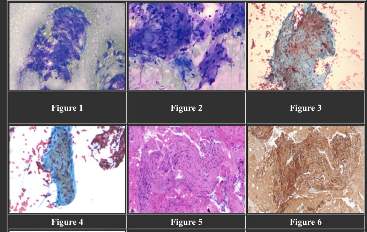 Papanicolaou Society (@papsociety) on Twitter photo Case of the Month:<a href="/PapSociety/">Papanicolaou Society</a>
68M, ex- smoker, presents with hemoptysis & SOB.
CT chest: 2.5 cm mildly hypermetabolic R hilar mass
EUS-guided FNA performed.
What’s your diagnosis? <a href="/IACytology/">International Academy Cytology</a> @britishcytology <a href="/DiagnosticCyto/">Diagnostic Cytopath</a> <a href="/AzizaNassar2/">Aziza Nassar</a>
papsociety.com/cotm24/cotmdec… Case of the Month:<a href="/PapSociety/">Papanicolaou Society</a>
68M, ex- smoker, presents with hemoptysis & SOB.
CT chest: 2.5 cm mildly hypermetabolic R hilar mass
EUS-guided FNA performed.
What’s your diagnosis? <a href="/IACytology/">International Academy Cytology</a> @britishcytology <a href="/DiagnosticCyto/">Diagnostic Cytopath</a> <a href="/AzizaNassar2/">Aziza Nassar</a>
papsociety.com/cotm24/cotmdec…