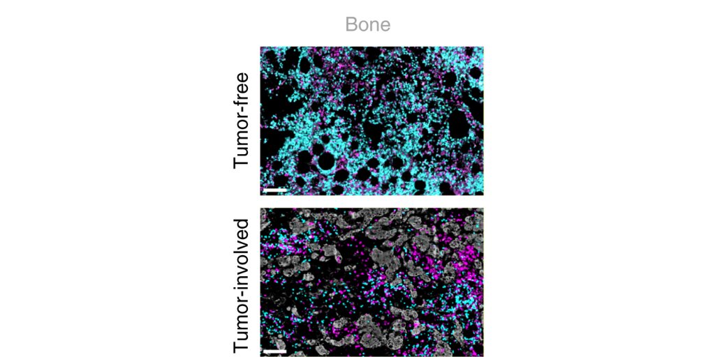 Organ-Specific Immune Setpoints Underlie Divergent Immune Profiles across Metastatic Sites in Breast Cancer. bit.ly/4hXNKMP