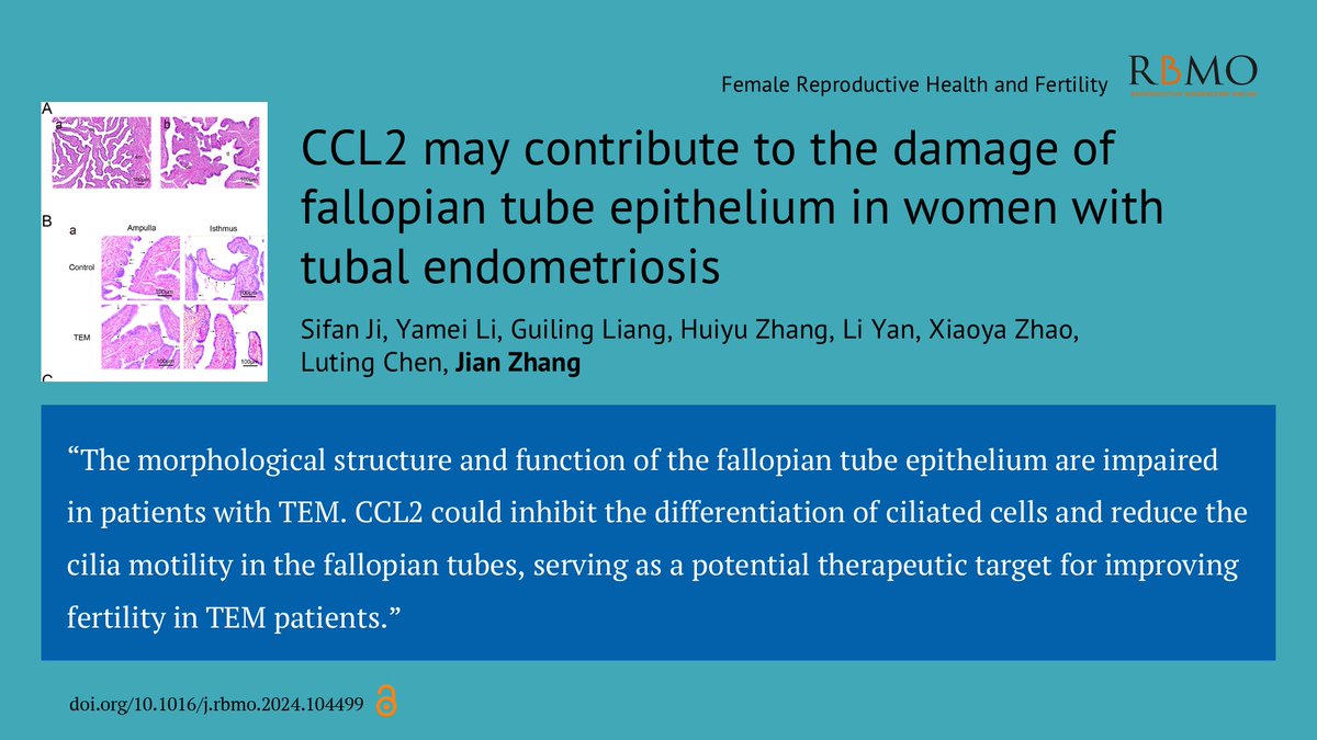 Reproductive BioMedicine Online (@rbmonline) on Twitter photo The morphological structure and function of the fallopian tube epithelium are shown to be impaired in patients with tubal endometriosis, in this new paper from a team at Shanghai Key Laboratory of Embryo Original Diseases.
doi.org/10.1016/j.rbmo… The morphological structure and function of the fallopian tube epithelium are shown to be impaired in patients with tubal endometriosis, in this new paper from a team at Shanghai Key Laboratory of Embryo Original Diseases.
doi.org/10.1016/j.rbmo…