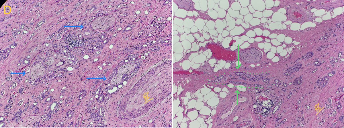 👉 Reporting of prostatectomy:
 
Points to keep in mind while scanning slides
•Histologic type
•Gleason score with Grade group
•If pattern 4 is present, assess the percentage
•Pattern 5 present or not (even if tertiary, it’s important)
•Cribriform glands
•Percentage of