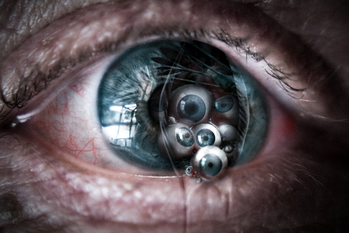 Hyperoculia is a condition where stem cells in the eyes reactivate, producing a series of smaller "false eyes" inside the vitreous body.
The pseudocular structures accumulate over time, leading to blindness. The pressure they create can be enough to eventually make the eye burst.