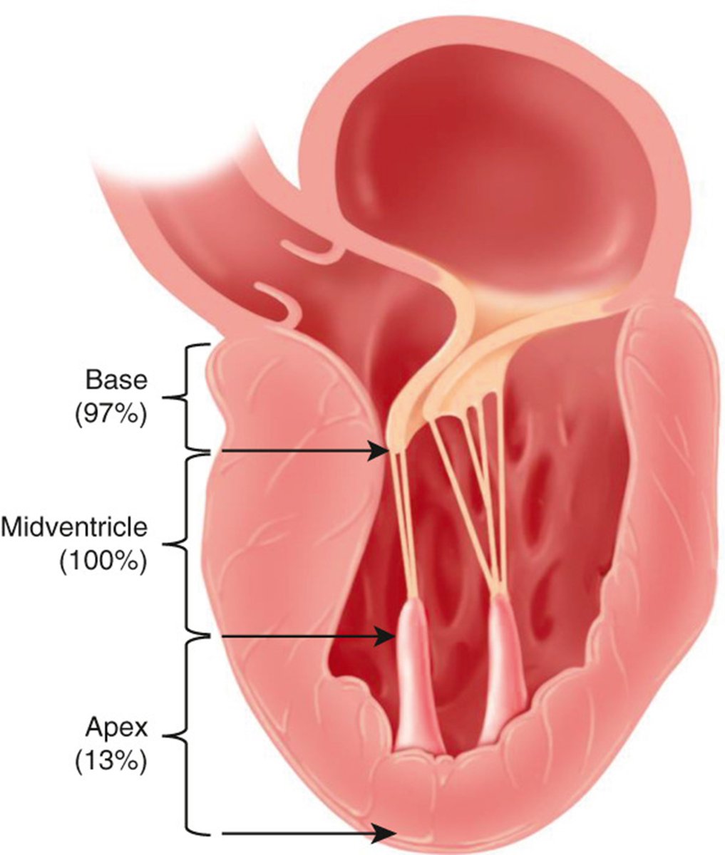 AATS (@aatshq) on Twitter photo What is the efficacy and safety of a transaortic approach to midventricular and apical septal myectomy? Researchers at <a href="/CleClinicHVTI/">Cleveland Clinic Heart, Vascular & Thoracic</a> find out in #JTCVS. Read the open access article: doi.org/10.1016/j.jtcv…
<a href="/AaronWeissMD/">Aaron J. Weiss, MD PhD</a> <a href="/David_Moros17/">David Moros</a> What is the efficacy and safety of a transaortic approach to midventricular and apical septal myectomy? Researchers at <a href="/CleClinicHVTI/">Cleveland Clinic Heart, Vascular & Thoracic</a> find out in #JTCVS. Read the open access article: doi.org/10.1016/j.jtcv…
<a href="/AaronWeissMD/">Aaron J. Weiss, MD PhD</a> <a href="/David_Moros17/">David Moros</a>