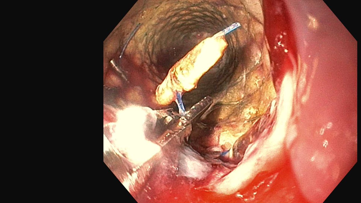 DouglasAdlerMD's tweet photo. Using endoscopic scissors to cut sutures to remove a stent placed months ago at OSH. The scissors are very effective! #gitwitter https://t.co/1mxwVFVPV7