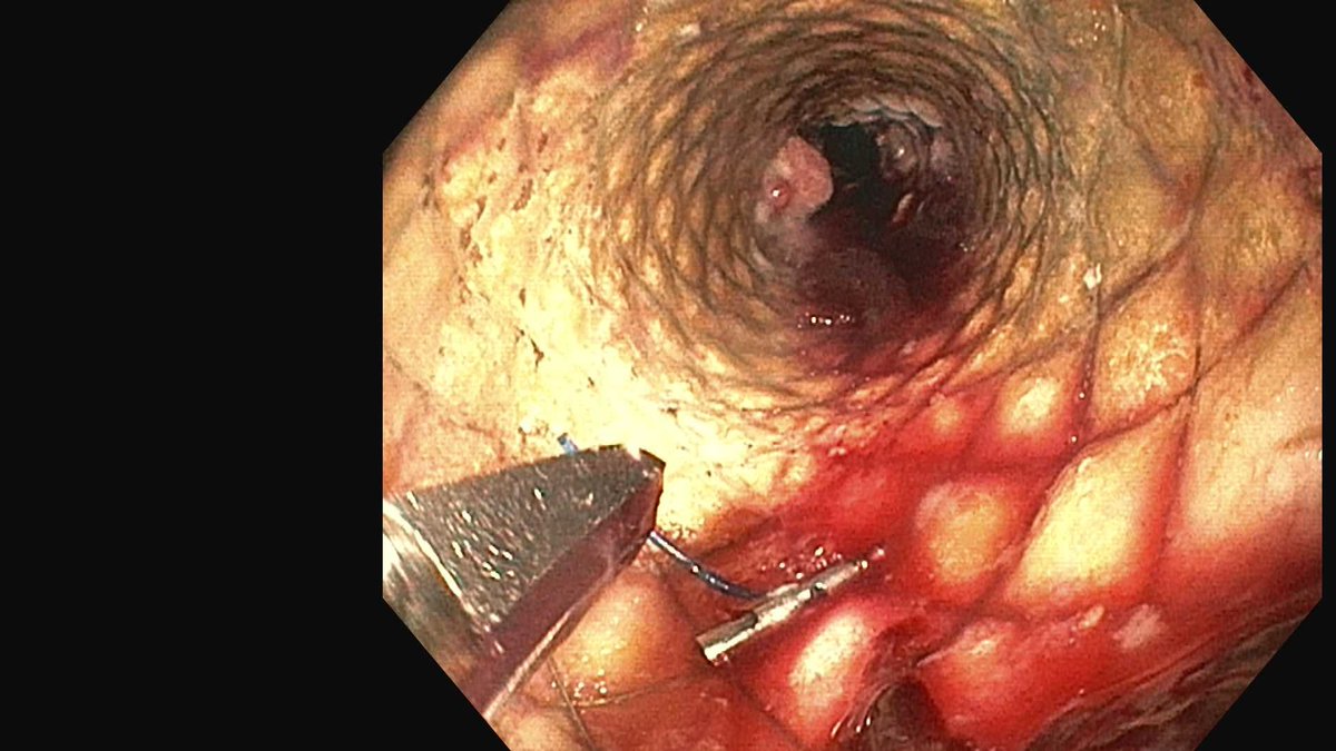 DouglasAdlerMD's tweet photo. Using endoscopic scissors to cut sutures to remove a stent placed months ago at OSH. The scissors are very effective! #gitwitter https://t.co/1mxwVFVPV7