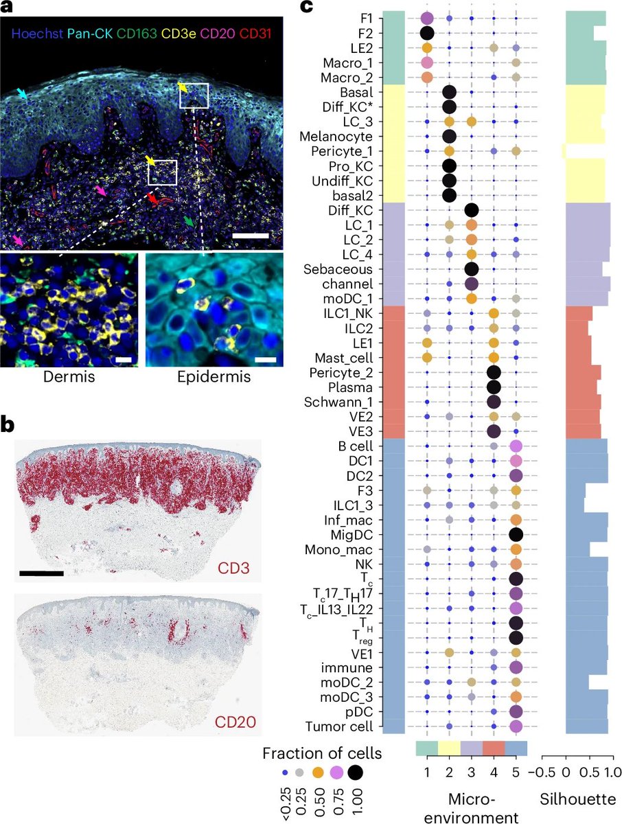 Waggoner Lab (@labwaggoner) on Twitter photo Cutaneous T cell lymphoma atlas reveals malignant TH2 cells supported by a B cell-rich tumor microenvironment <a href="/NatImmunol/">Nature Immunology</a> <a href="/Muzz_Haniffa/">Muzlifah Haniffa</a> <a href="/teichlab/">Teichlab</a> <a href="/RuoyanLi/">Ruoyan Li</a>
nature.com/articles/s4159… Cutaneous T cell lymphoma atlas reveals malignant TH2 cells supported by a B cell-rich tumor microenvironment <a href="/NatImmunol/">Nature Immunology</a> <a href="/Muzz_Haniffa/">Muzlifah Haniffa</a> <a href="/teichlab/">Teichlab</a> <a href="/RuoyanLi/">Ruoyan Li</a>
nature.com/articles/s4159…