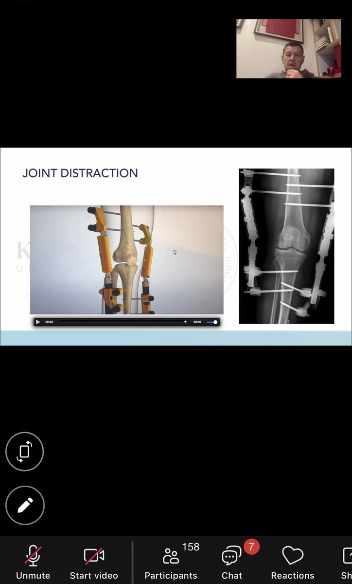 BhamKnee_Should's tweet photo. An insightful zoom tonight with Professor Martyn Snow, who gave a clinical talk on knee preservation surgery. 

Thank you also to our 160+ GP, Physiotherapy and AHP attendees who participated 

For info on future sessions email michelle@midlandorthopaedicpractice.co.uk 

#knees https://t.co/dcRjezAQKU