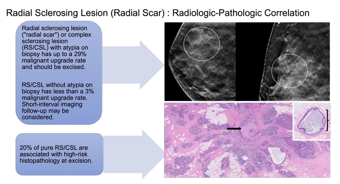 Journal of Breast Imaging (@jbi_sbi) on Twitter photo 🌟 LATEST RAD-PATH ARTICLE IN #JBI🌟
✨Radial Sclerosing Lesion (Radial Scar): <a href="/StanfordRad/">Stanford Radiology</a>
✨RS/CSL with atypia at CNB have a 16%to 29% rate of upgrade to malignancy on surg excision, rendering surgical excision essential.
👇🏻👇🏻👇🏻
doi.org/10.1093/jbi/wb… 🌟 LATEST RAD-PATH ARTICLE IN #JBI🌟
✨Radial Sclerosing Lesion (Radial Scar): <a href="/StanfordRad/">Stanford Radiology</a>
✨RS/CSL with atypia at CNB have a 16%to 29% rate of upgrade to malignancy on surg excision, rendering surgical excision essential.
👇🏻👇🏻👇🏻
doi.org/10.1093/jbi/wb…