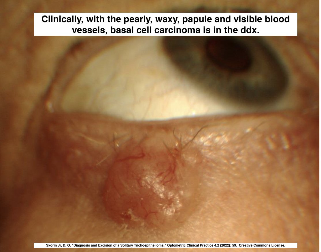 Path4People's tweet image. I am a great mimic of basal cell carcinoma.

I am a hair follicle tumor.

I am seen generally on the face, and some versions of me, I look like a paisley tie.  

Who am I? 🤔 

#pathx #dermpath #fammed #medx #pathtwitter #path4people #pathagonia