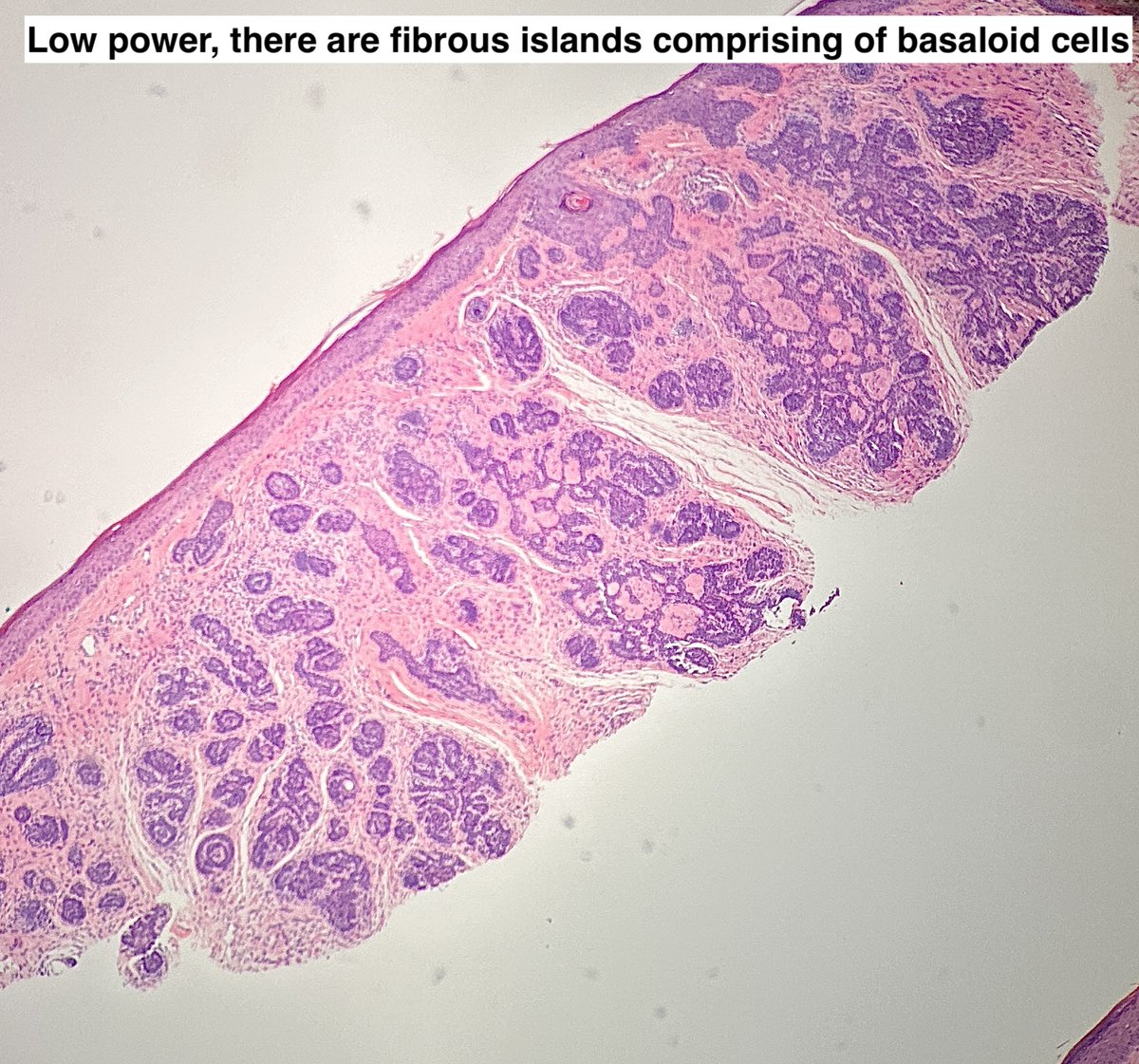 Path4People's tweet image. I am a great mimic of basal cell carcinoma.

I am a hair follicle tumor.

I am seen generally on the face, and some versions of me, I look like a paisley tie.  

Who am I? 🤔 

#pathx #dermpath #fammed #medx #pathtwitter #path4people #pathagonia