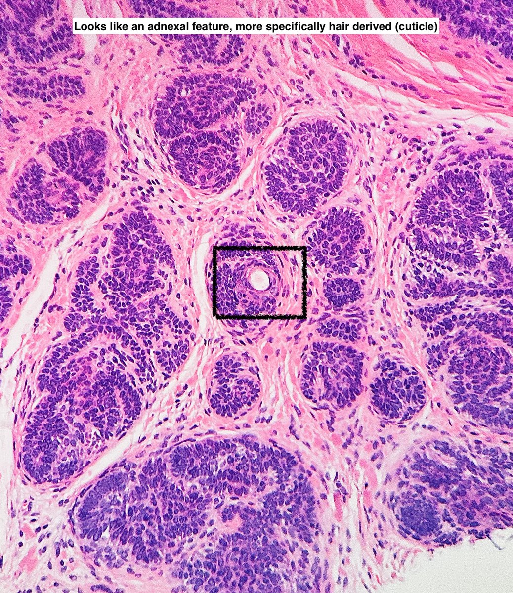 Path4People's tweet image. I am a great mimic of basal cell carcinoma.

I am a hair follicle tumor.

I am seen generally on the face, and some versions of me, I look like a paisley tie.  

Who am I? 🤔 

#pathx #dermpath #fammed #medx #pathtwitter #path4people #pathagonia