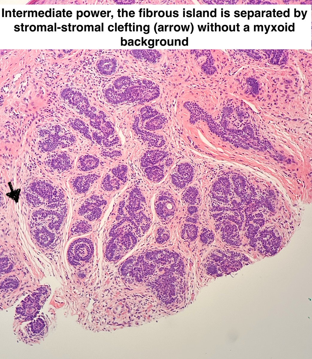 Path4People's tweet image. I am a great mimic of basal cell carcinoma.

I am a hair follicle tumor.

I am seen generally on the face, and some versions of me, I look like a paisley tie.  

Who am I? 🤔 

#pathx #dermpath #fammed #medx #pathtwitter #path4people #pathagonia