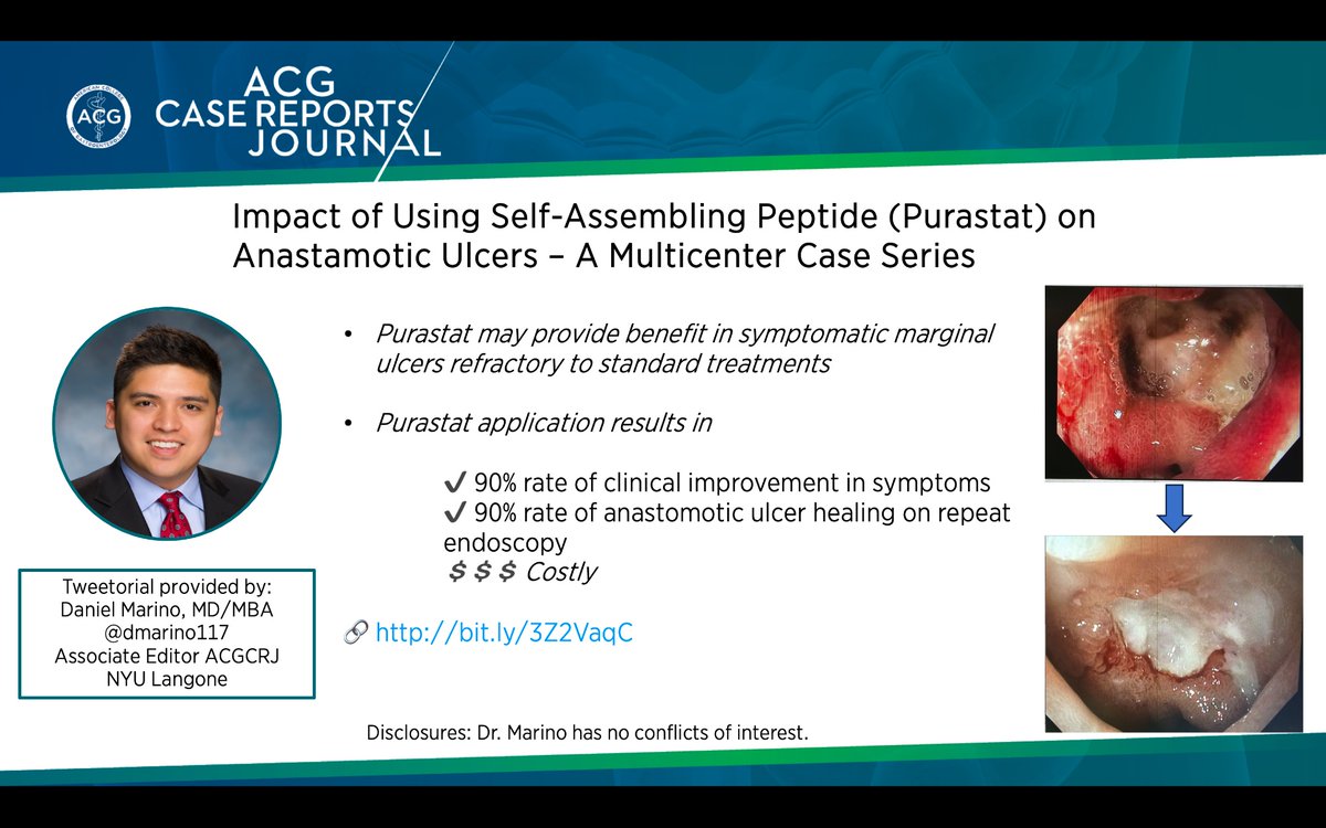 ACGCRJ (@acgcrj) on Twitter photo ⏰ for #CaseoftheMonth Tweetorial #ACGCRJ
w/<a href="/dmarino117/">Dan Marino MD MBA</a>
👉Consider Purastat for symptomatic refractory marginal ulcers described by <a href="/DrVeeral/">Veeral M. Oza</a> <a href="/YouseffazelMD/">Yousef Fazel</a> <a href="/MohitGirotra/">Mohit Girotra, MD, AGAF, FASGE, FACG, FACP</a> <a href="/HarshitKharaMD/">Harshit S. Khara, MD, FACG, FASGE</a> <a href="/ShivangiKMD/">Shivangi Kothari</a> <a href="/Tkothari13/">Truptesh H. Kothari MD, MS, FACG, FASGE</a>
📚bit.ly/3Z2VaqC
<a href="/NadeemYousafMD/">Nadeem Yousaf</a> <a href="/PrateekHarne1/">Prateek Harne MBBS, MD</a> ⏰ for #CaseoftheMonth Tweetorial #ACGCRJ
w/<a href="/dmarino117/">Dan Marino MD MBA</a>
👉Consider Purastat for symptomatic refractory marginal ulcers described by <a href="/DrVeeral/">Veeral M. Oza</a> <a href="/YouseffazelMD/">Yousef Fazel</a> <a href="/MohitGirotra/">Mohit Girotra, MD, AGAF, FASGE, FACG, FACP</a> <a href="/HarshitKharaMD/">Harshit S. Khara, MD, FACG, FASGE</a> <a href="/ShivangiKMD/">Shivangi Kothari</a> <a href="/Tkothari13/">Truptesh H. Kothari MD, MS, FACG, FASGE</a>
📚bit.ly/3Z2VaqC
<a href="/NadeemYousafMD/">Nadeem Yousaf</a> <a href="/PrateekHarne1/">Prateek Harne MBBS, MD</a>