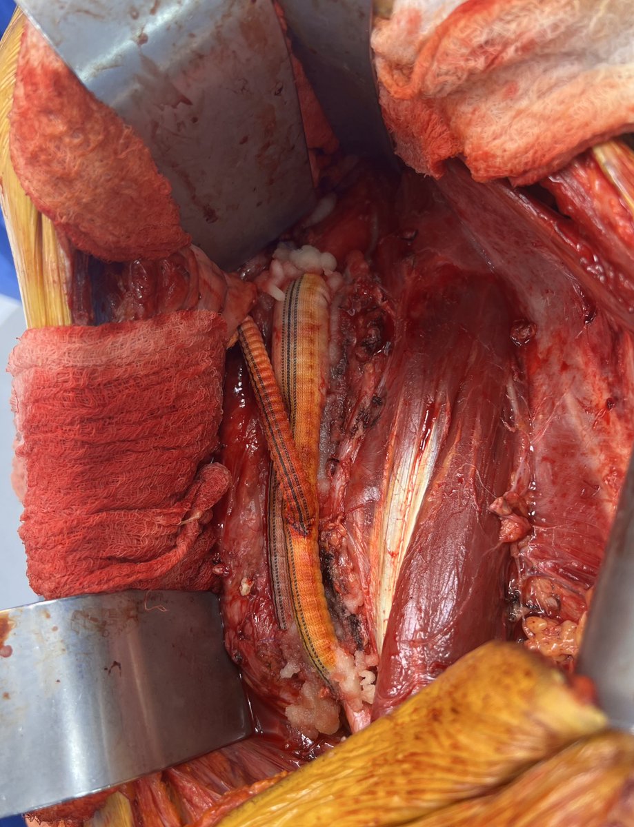 It's great week when you start with a TOS end up doing 2 open aorta; 1 TEVAR, 1 BKA, 2 Fem endart with iliac stents; 2 SFA stents, 2 TOS; 3 venograms; 1 mesenteric stent and finally a good old fashioned fem-embolectomy <a href="/WashUVascular/">WashU Medicine Division of Vascular Surgery</a> <a href="/WashUSurgery/">WashU Medicine Department of Surgery</a> 
<a href="/westleyohman/">Westley Ohman</a> <a href="/DrPatGeraghty/">Patrick Geraghty</a>