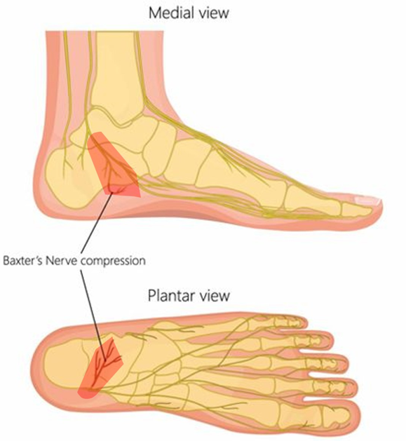 NickIlic_Physio's tweet photo. Q: When is Plantar Fasciitis not Plantar Fasciitis? 
A: When it’s Baxter’s Nerve.

Not all heel pain is Plantar Fasciopathy. 
Look for:
Medial heel symptoms climbing upward
Ankle injury/persistent irritation history
Pain-free calcaneal tubercle on palpation
Footwear compression https://t.co/KouSBQgypB