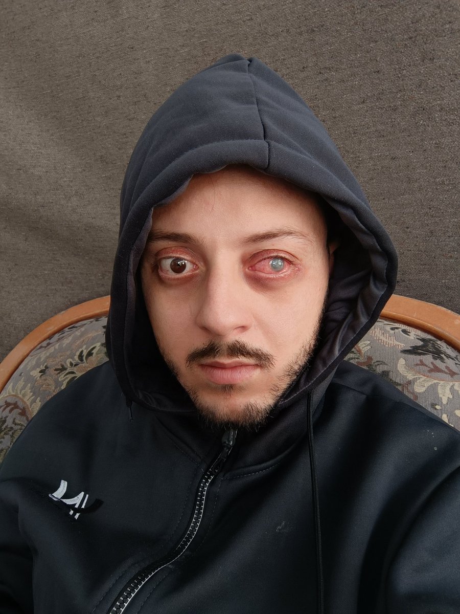 ahmedshameya995's tweet image. My eye has not stopped hurting me, and i live my worst nightmare 😭 
Pray for me please 
gofund.me/3fd33d14