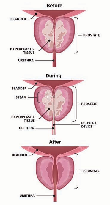 RegalHospital's tweet photo. Rezum Water Vapor Therapy is indeed a highly effective and minimally invasive option for treating Benign Prostatic Hyperplasia (BPH), and it https://t.co/AcCevcDHil